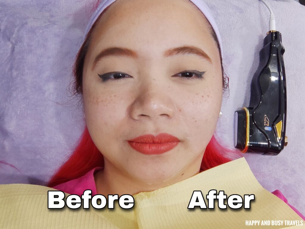 result hifu rf face slimming 360 degree Beauty Lounge Spa Salon Piela Dasmarinas Cavite - Happy and Busy Travels